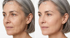 Before and after skin results with Lumora