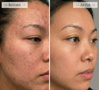 Before and after skin results with Lumora